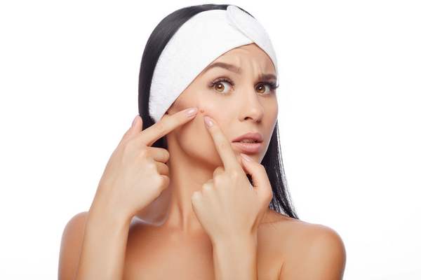 Cause esterne di Acne