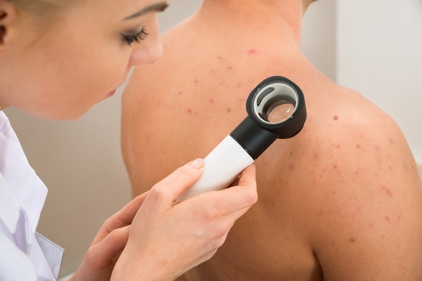 Come sbarazzarsi di acne sul corpo?