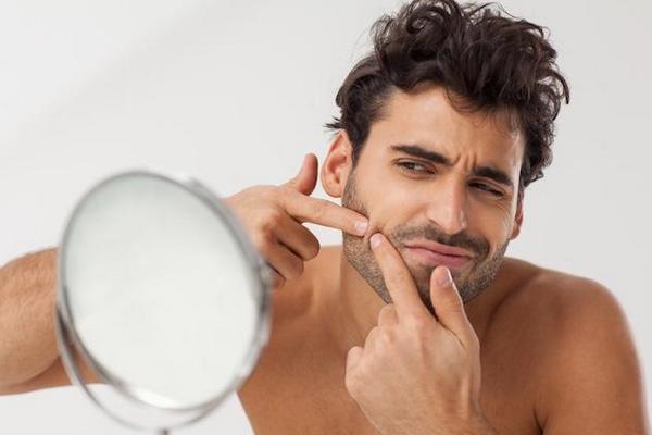 Cause interne della pelle Acne